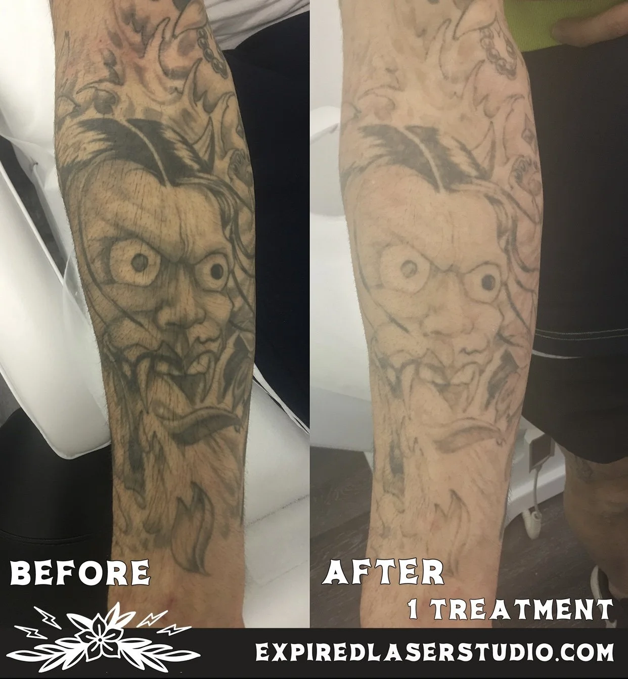 laser-tattoo-fading-canberra-clinic.jpg