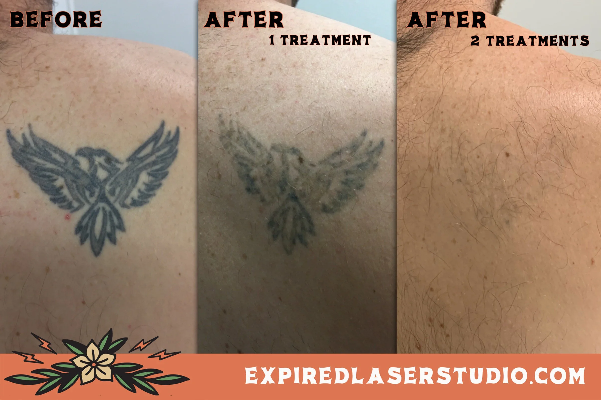 laser-tattoo-removal-canberra-black-ink.jpg