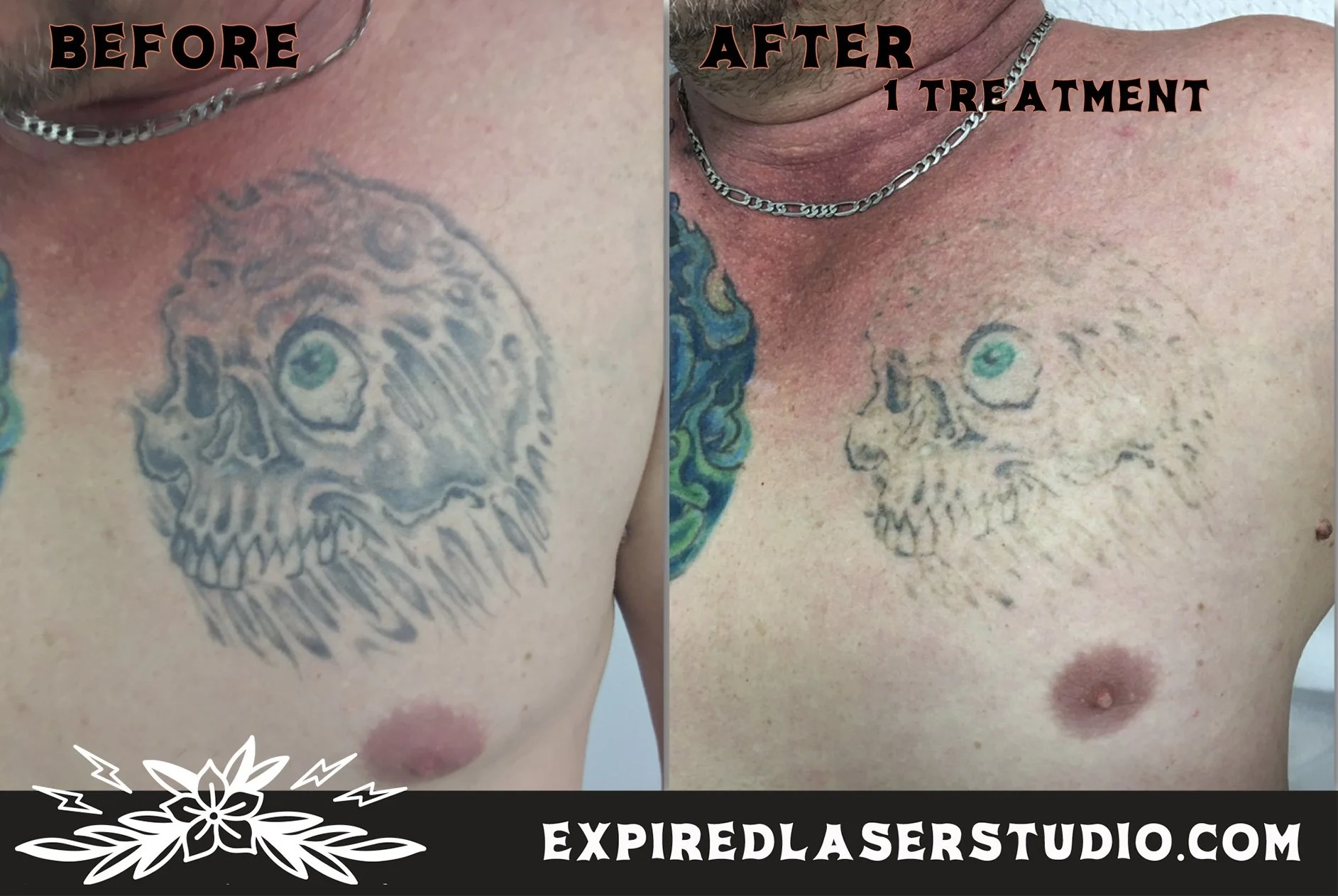 professional-tattoo-removal-results.jpg