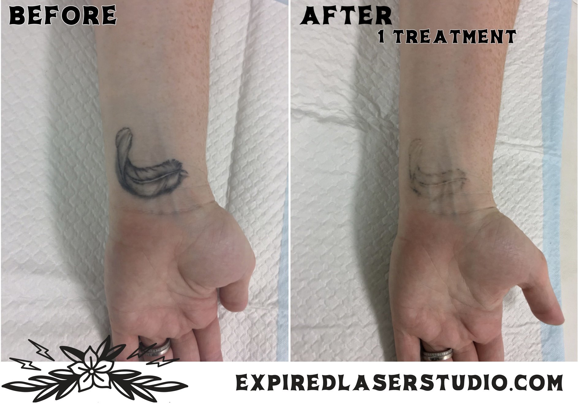 script-tattoo-removal-before-after.jpg