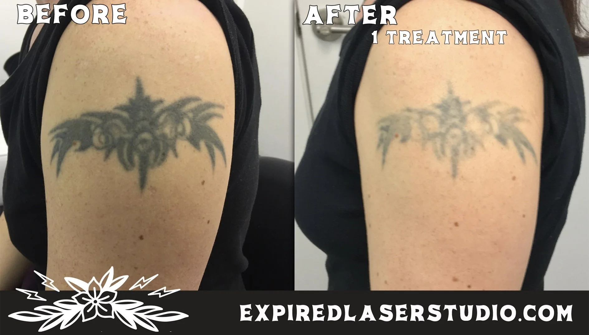 tattoo-removal-consultation-results.jpg