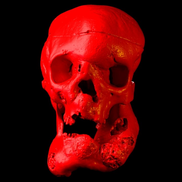 Acromegalic Skull Reconstruction.jpg