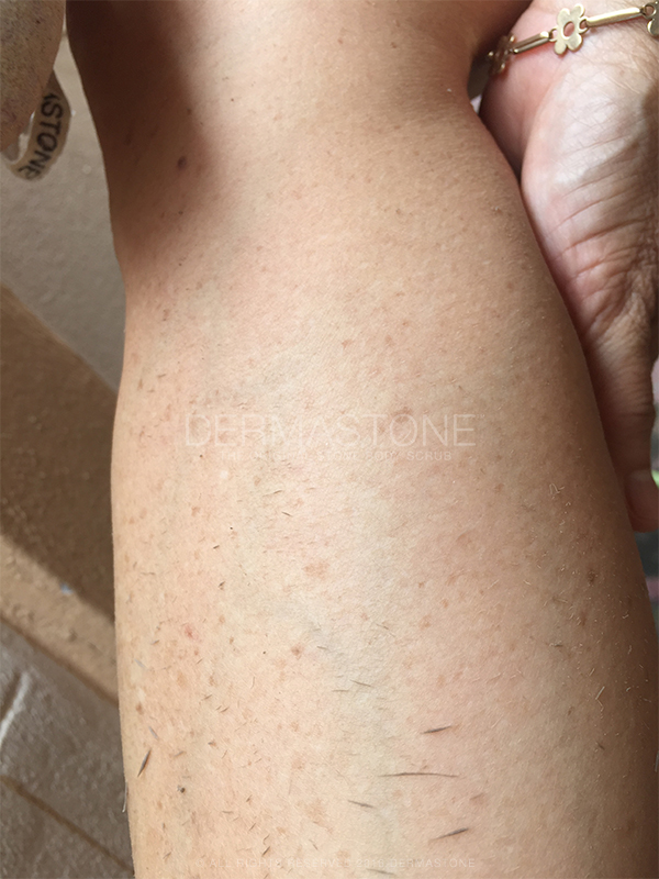 Legs - Dead Skin Removal with Dermastone™ Leg & Body Scrub