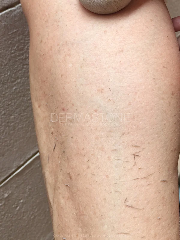 Legs - Dead Skin Removal with Dermastone™ Leg & Body Scrub