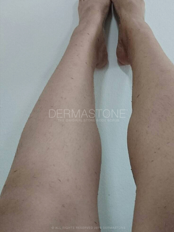 Legs - Dead Skin Removal with Dermastone™ Leg & Body Scrub