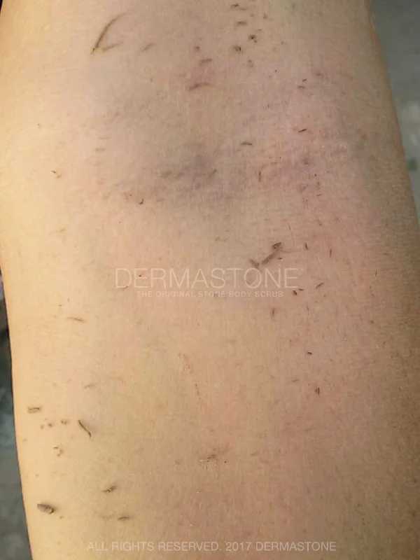 Arms - Dead skin removal to reveal brighter skin