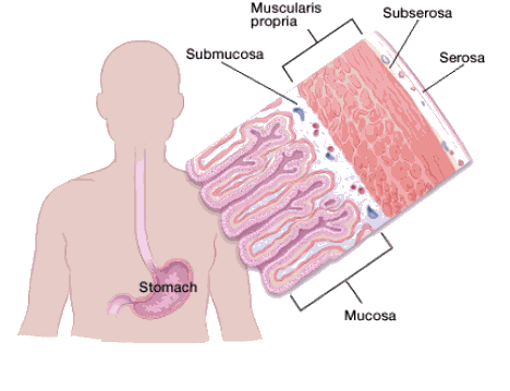 Figure 1. The stomach is made up of several layers. The stage of cancer depends in part of how many layers are invaded by cancer. Image credit: American Cancer Society