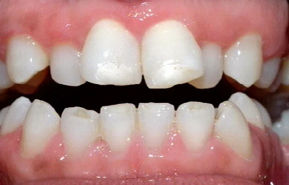 Crooked teeth are prone to gum disease