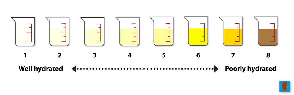 From KidneyStoners.org
