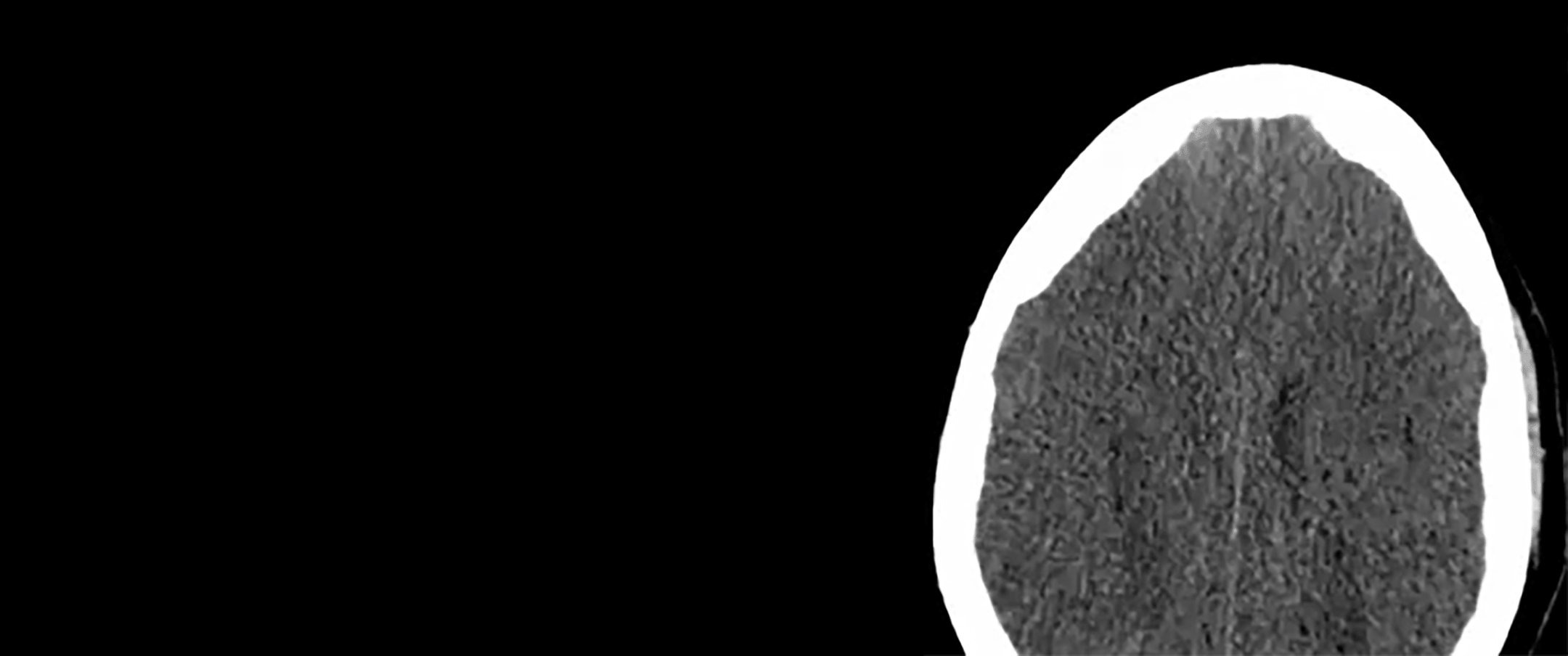 cerebraledema2.gif