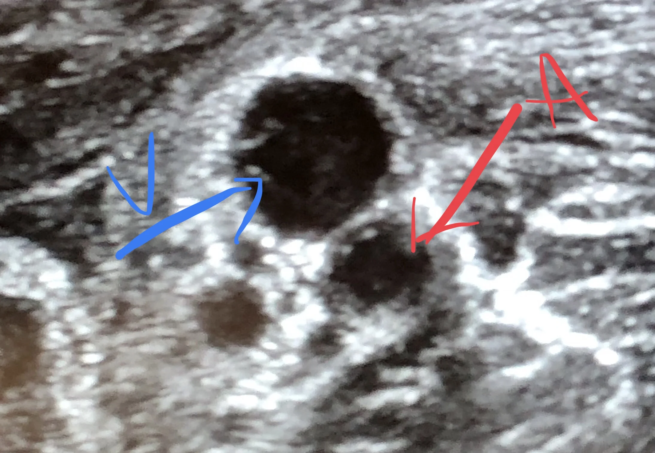 Above: a vein and artery on ultrasound. Veins are usually larger with hypo-echoic walls; when you press down on it, it will easily collapse. Arteries, in contrast, are going to be smaller with sometimes hyper-echoic walls (Think PAD). Arteries also pulsate when you push down on them with slight pressure (push down too much and you will obstruct all flow).
