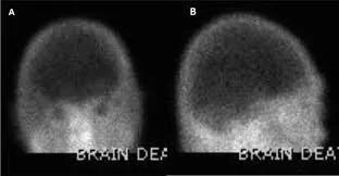 Clinical Brain Death Determination: Step-by-Step Guide — Pulmcast | ICU ...