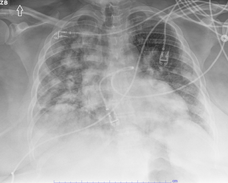 Reading Imaging — Pulmcast | ICU APP Fellowship | Critical Care Training