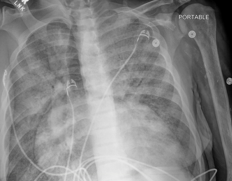 Reading Imaging — Pulmcast | ICU APP Fellowship | Critical Care Training