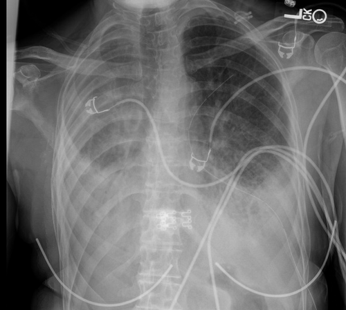 Reading Imaging — Pulmcast | ICU APP Fellowship | Critical Care Training
