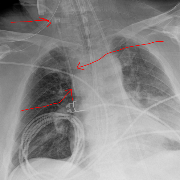 Reading Imaging — Pulmcast | ICU APP Fellowship | Critical Care Training