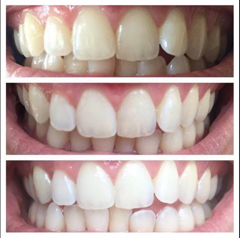 Teeth Whitening Paste- Results in 7 Days *No Bleach *No Peroxide *No Sensitivity *No Tray