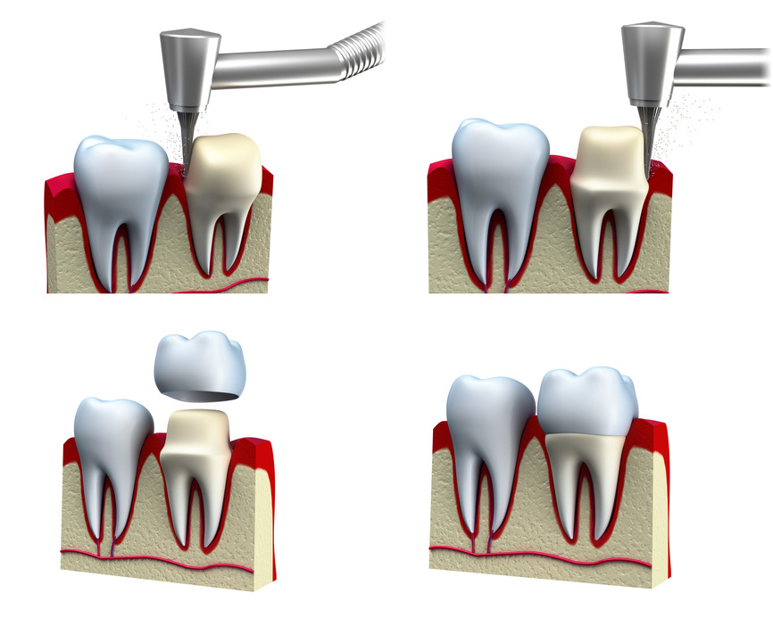 photodune-11613557-dental-crown-installation-process-isolated-on-white-s.jpg
