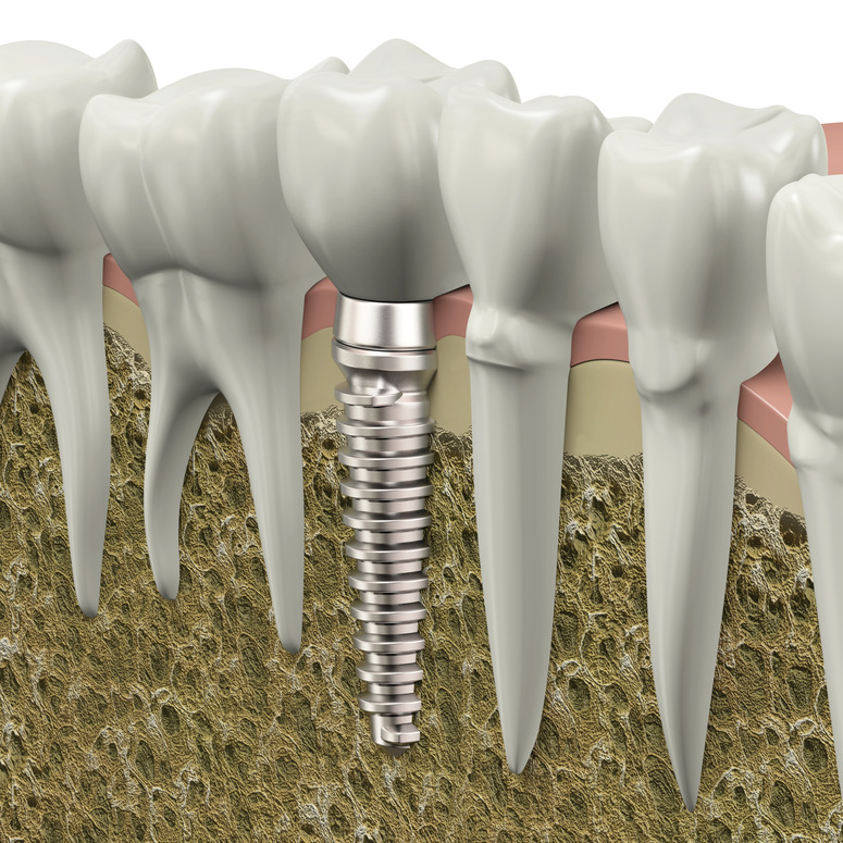 PAID-dental-implant-s.jpg