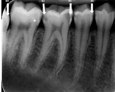"Kissing Caries" - Farida et al, 2012