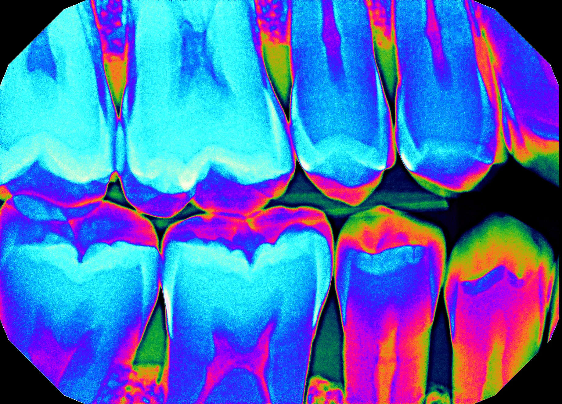 Color enhancement made possible with digital technology helps your dentist with diagnosis.