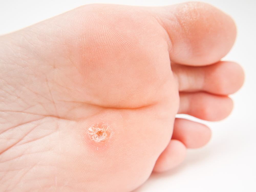 wart foot cancer)