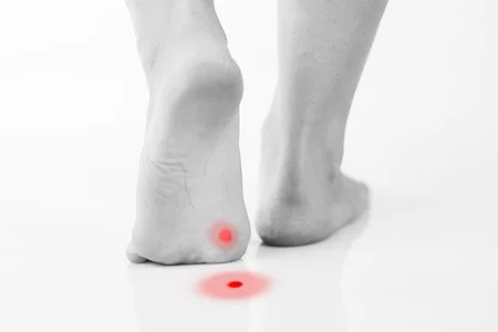 35378761_S_callus_wart_foot_pain_blister_wound.jpg