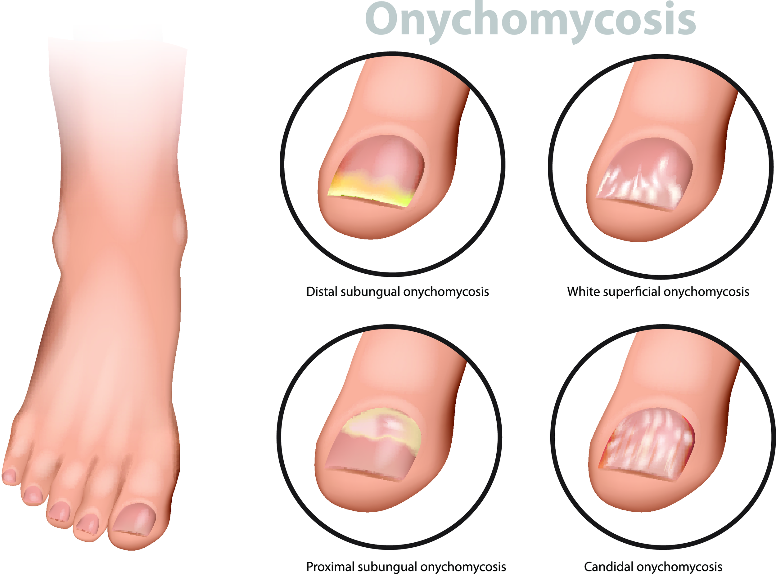 treatment of nail fungus in child