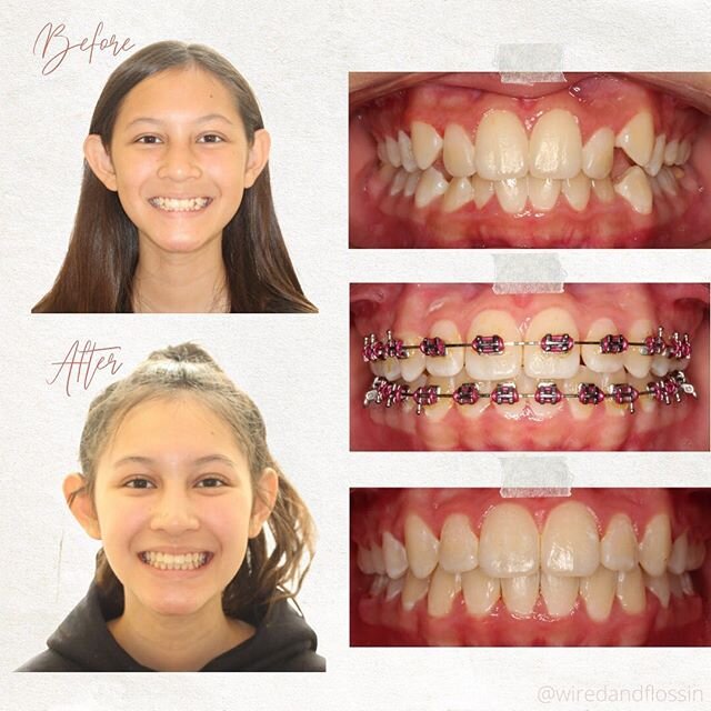 ✨Look at this smile #transform✨ .
.
This patient had pretty crowded teeth that made her self conscious about her #smile. With just about 16 months of #orthodontic treatment, this patient got a smile she loves!
.
.
#orthodontictreatment #smiledesign #
