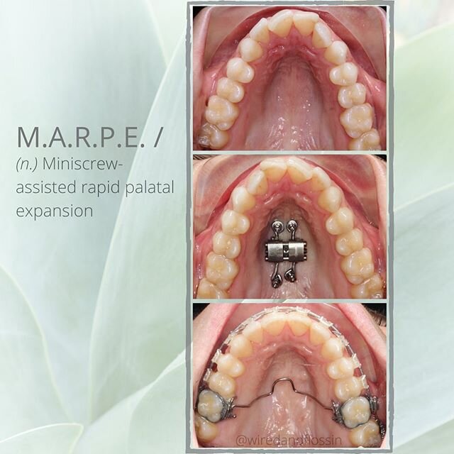 Let&rsquo;s talk about small upper jaws and what can be done to correct them ✨🙌🦷
.
.
One of the options is called a MARPE, short for miniscrew-assisted rapid palatal expansion. It&rsquo;s used mostly in adult patients or those who are not growing a