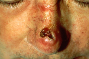 Wikipedia says this is squamous cell carcinoma.