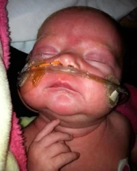 CDC file photo: infant with pertussis (whooping cough)