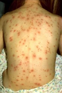 CDC file image of measles infection