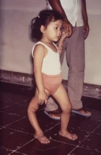 Polio victim showing deformity of leg from CDC Public Health Library