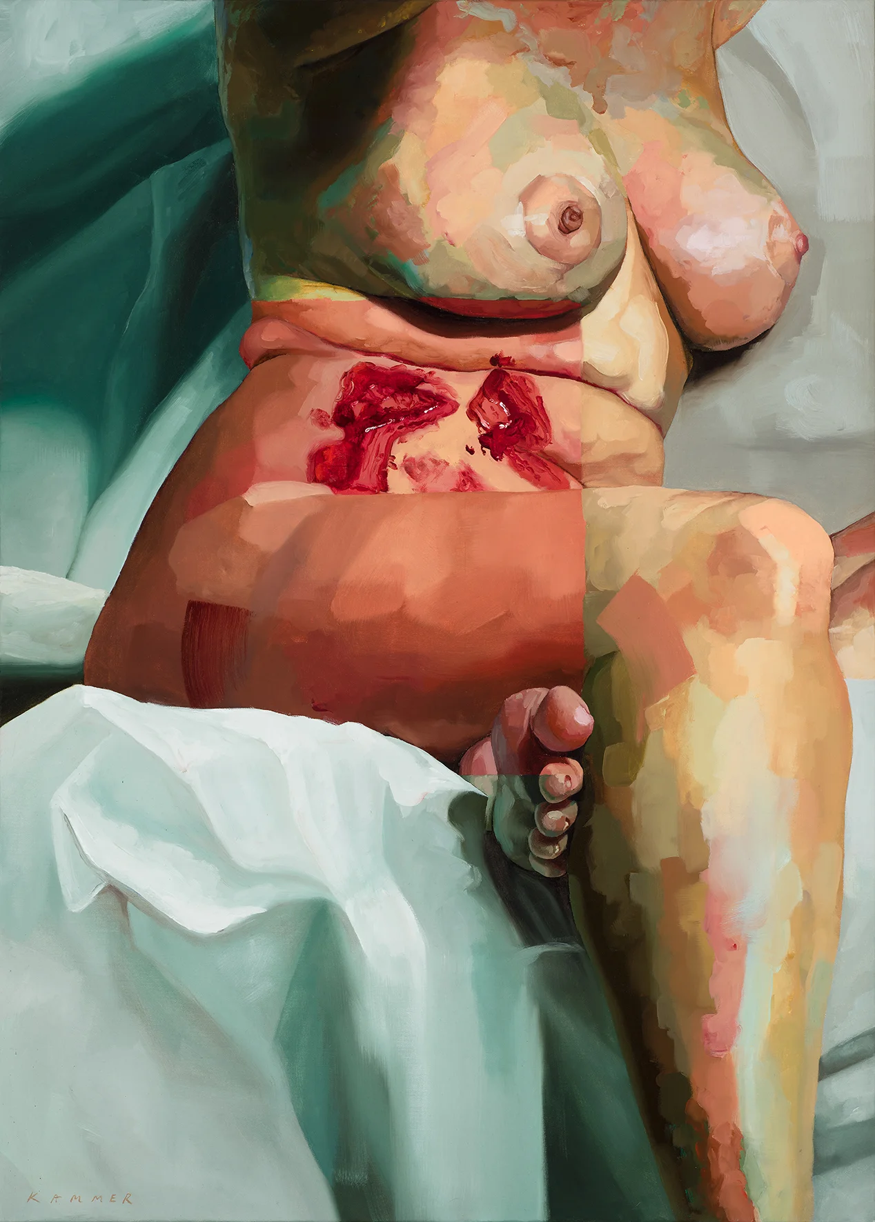 Endometriosis (Shadowed)