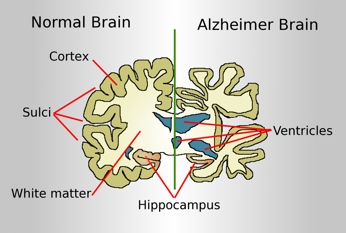 Alzheimer leads to nerve cell death and tissue degeneration throughout the brain, especially in hippocampus, responsible for the formation of new memories.