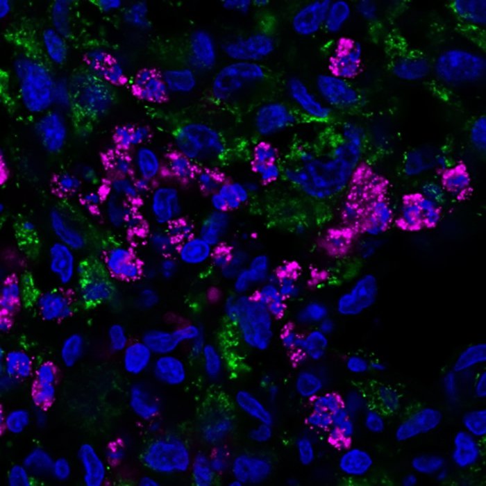 Bacteria (pink) sneakily infiltrating tumor cells (blue). Credit: Duke University