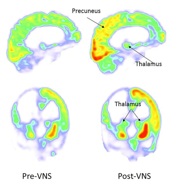 Left: PET scans (showing glucose metabolism and hence brain activity) before the vagus nerve stimulation. Right: PET scans after the stimulation showing increased brain activity in in the right parieto-occipital cortex and thalamus (all areas hypothesised to have something to do with consciousness). Corazzol, Lio et al., Current Biology (2017)