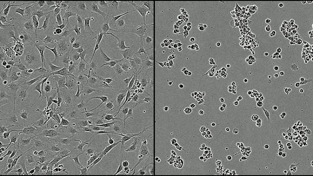 Glioblastoma cells under normal conditions (left) compared with glioblastoma cells after 48 hours of exposure to the mentioned synthetic chemical (right). At the picture to the right the cells are grouped together to undergo cell death. Credit: Wurdak Group, University of Leeds, UK.
