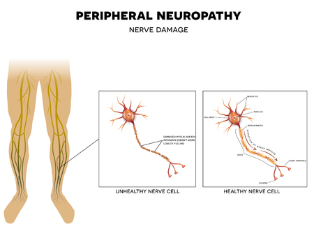 48215125_S_diabetes_peripheral_neuropathy_nerves_damage_legs_feet.jpg