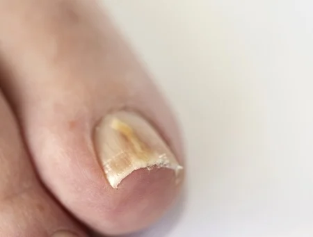 12433619_S_toe_nail_fungus_foot.jpg