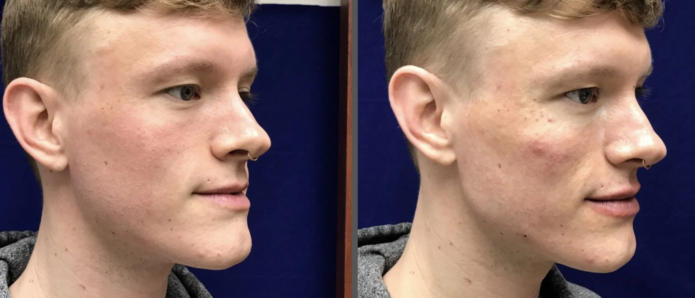 Mid Face Augmentation
