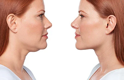 kybella-clinton-mi.jpg