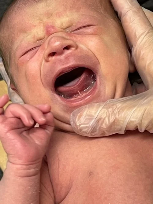Tongue and Lip Ties: What are they, and how can they affect breastfeeding? 