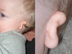 An example of microtia with aural atresia.