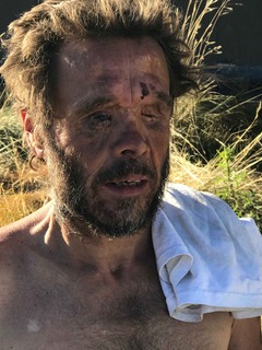 Linda’s brother, Mark. Linda says, “Mark’s face and head are held together with wires and metal plates. He lost both eyes, but they had one eye still connected by a sliver, so they tried to save that globe. It didn’t work and he’s 100% blind. Mark’s head was split T-shape across his face and eyes and he lost most of his frontal lobe. Through 55 other surgeries, he lost further brain matter. He has a metal rod from crotch to ankle. Most say he looks like Frankenstein. I still look at him, directly, — where the eyes to his soul used to be.”