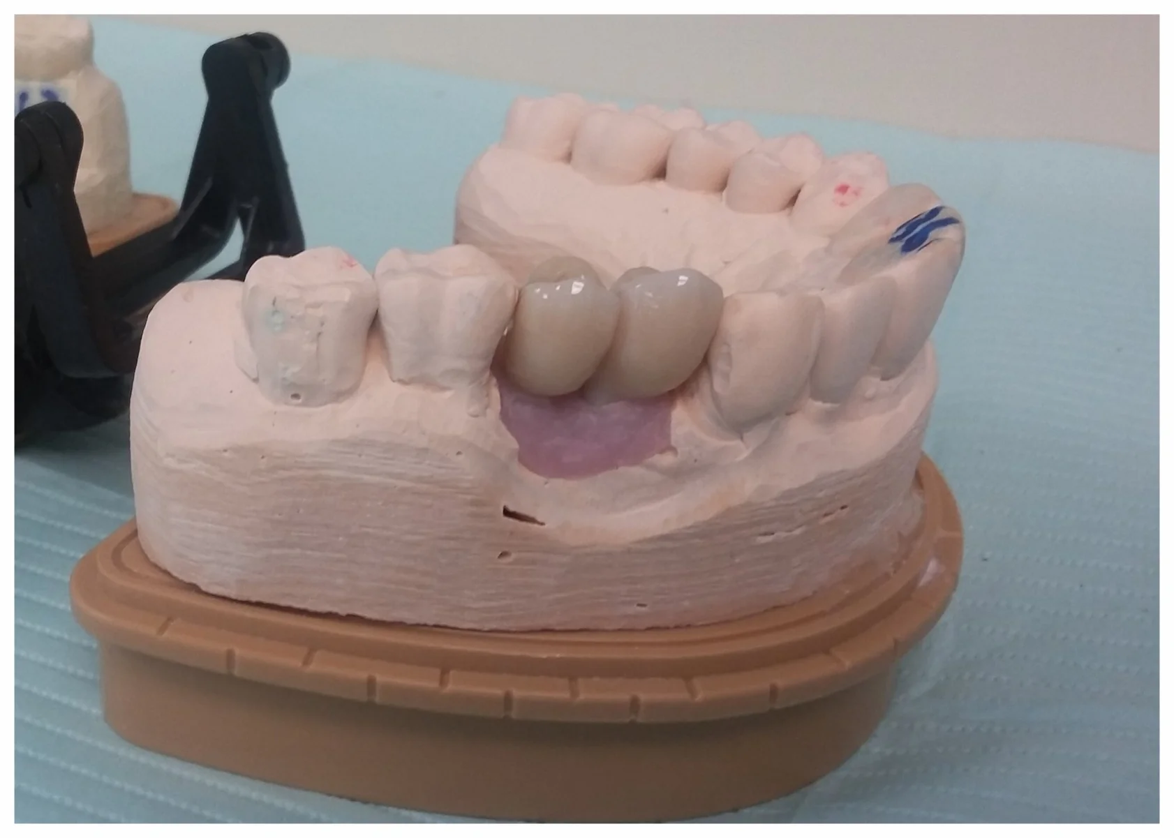 DENTAL IMPLANTS