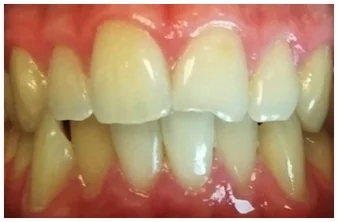 Chipped Front Teeth- Before Bonding