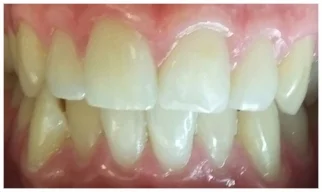 Chipped Front Teeth fixed with Composite Bonding (white fillings)