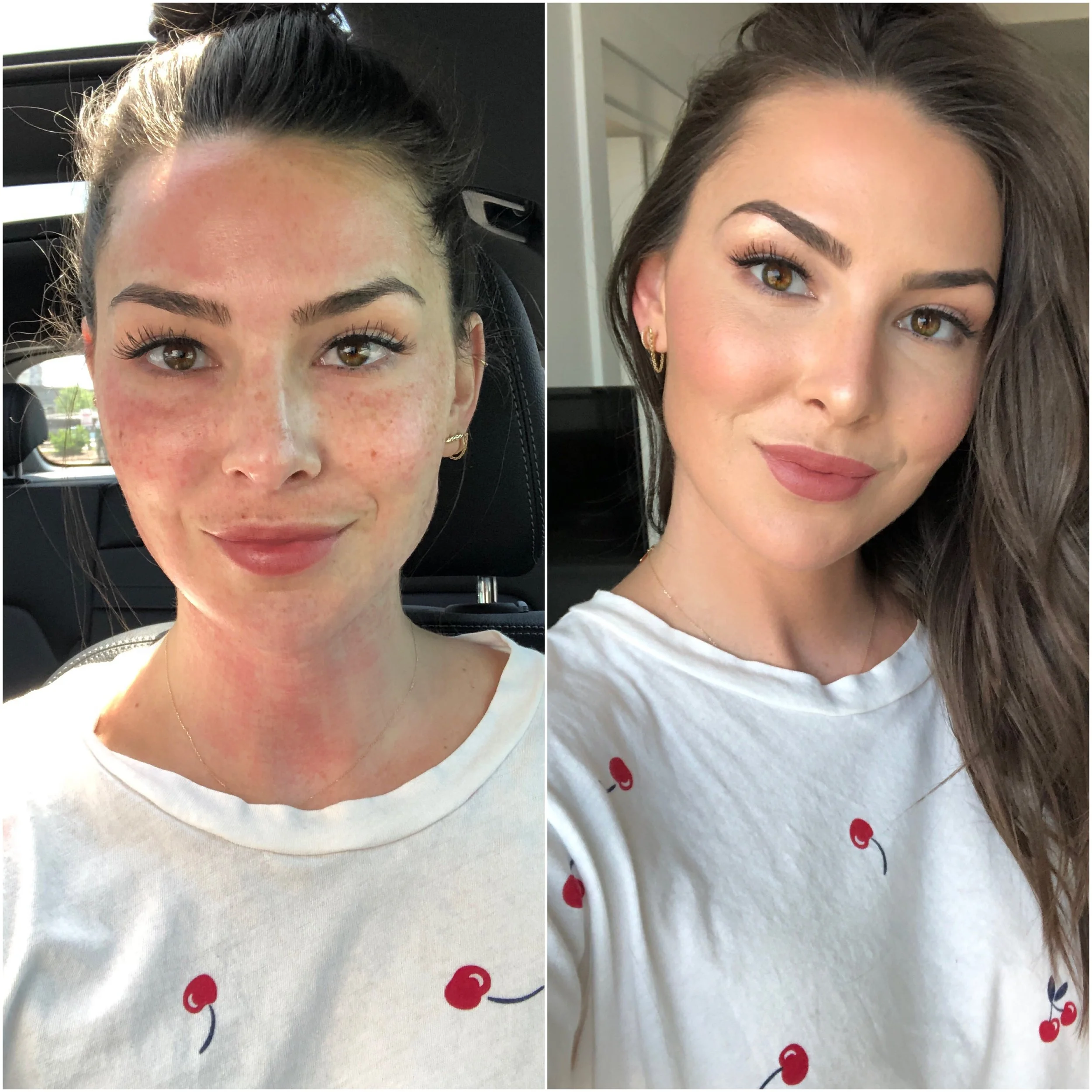 My Vivace RF Microneedling Experience